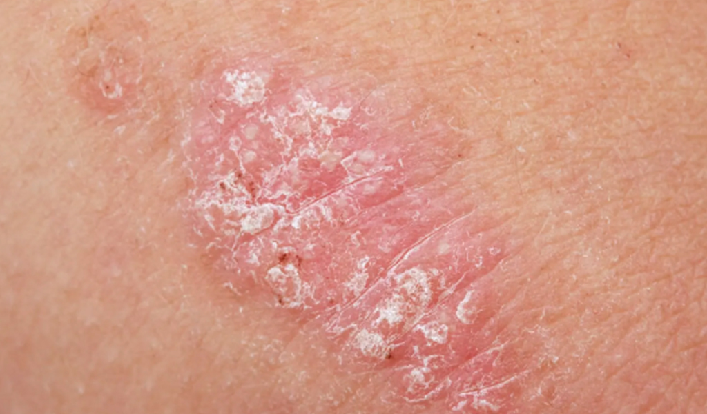 Management of Kitibha kushta (Psoriasis) with Shodhana Chikitsa and Customised Ayurveda Medications - A Case Report