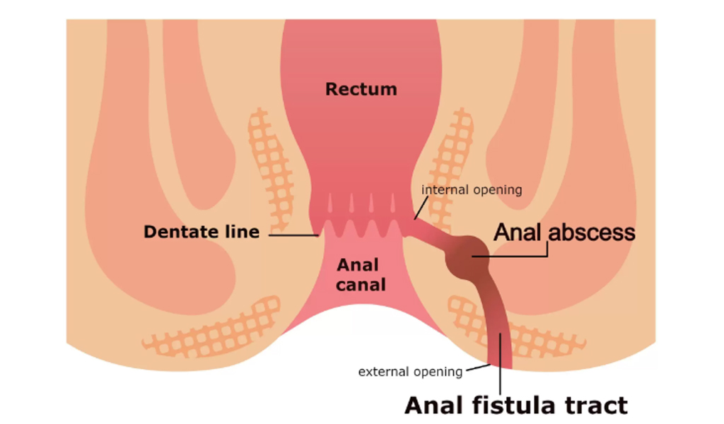 Challenges and Solutions: Managing a Complex Recurrent Fistula in Ano with Multiple Tracts using Kshara-Sutra in a follow-up of three months – A Case Report