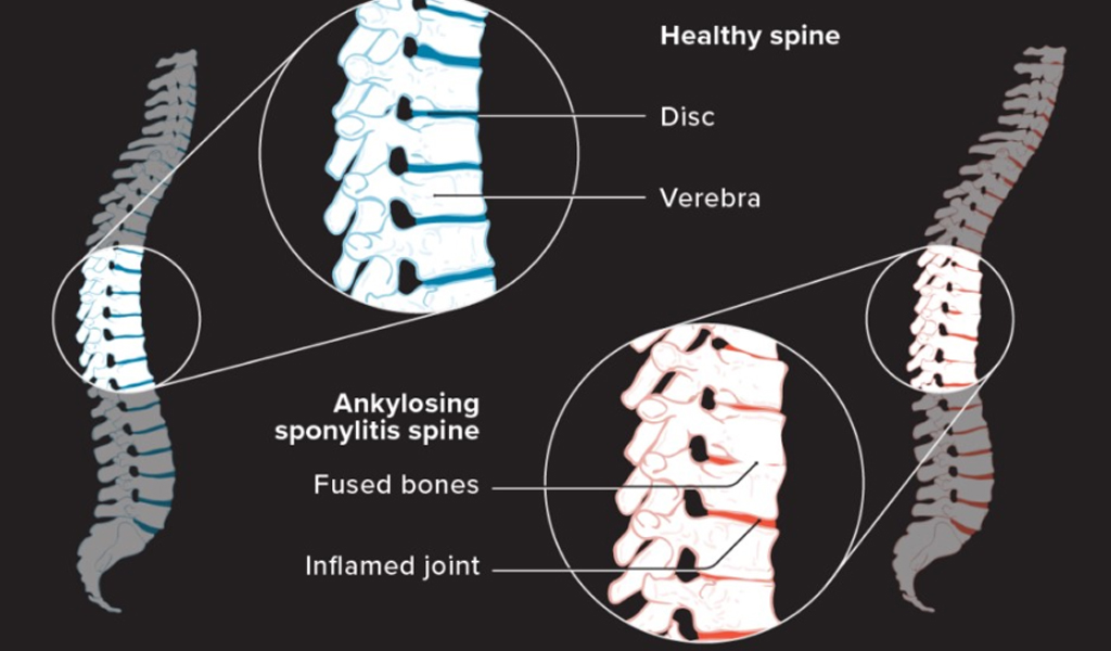 Efficacy of standalone personalized Ayurveda management in moderating inflammatory markers & radiological progression in Ankylosing Spondylitis with 11 years follow up – A Case Report