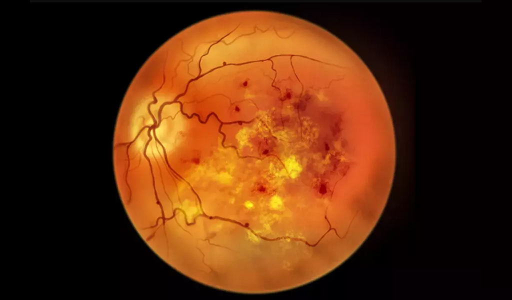 Management of high risk diabetic retinopathy: A Case report