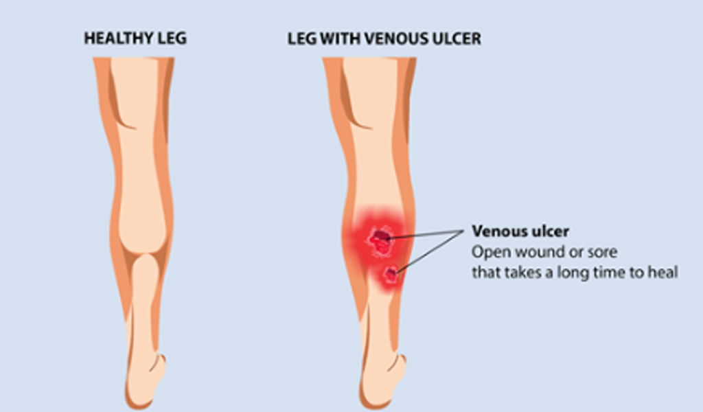 Minimal Invasive Management of Recurrent and Acute-on-Chronic Non-healing Venous Leg Ulceration through Ayurveda – a Case Report